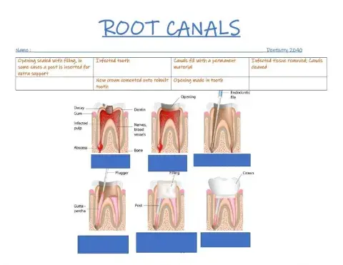 Root canal treatment