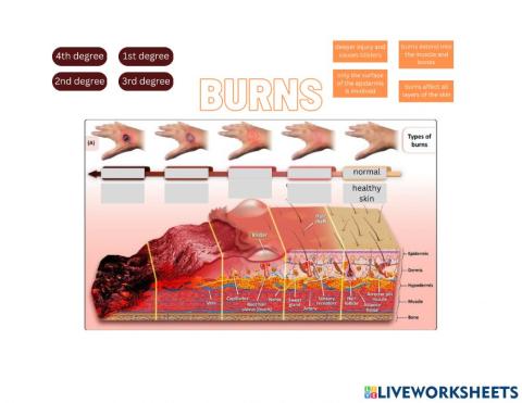 Burn Classifications