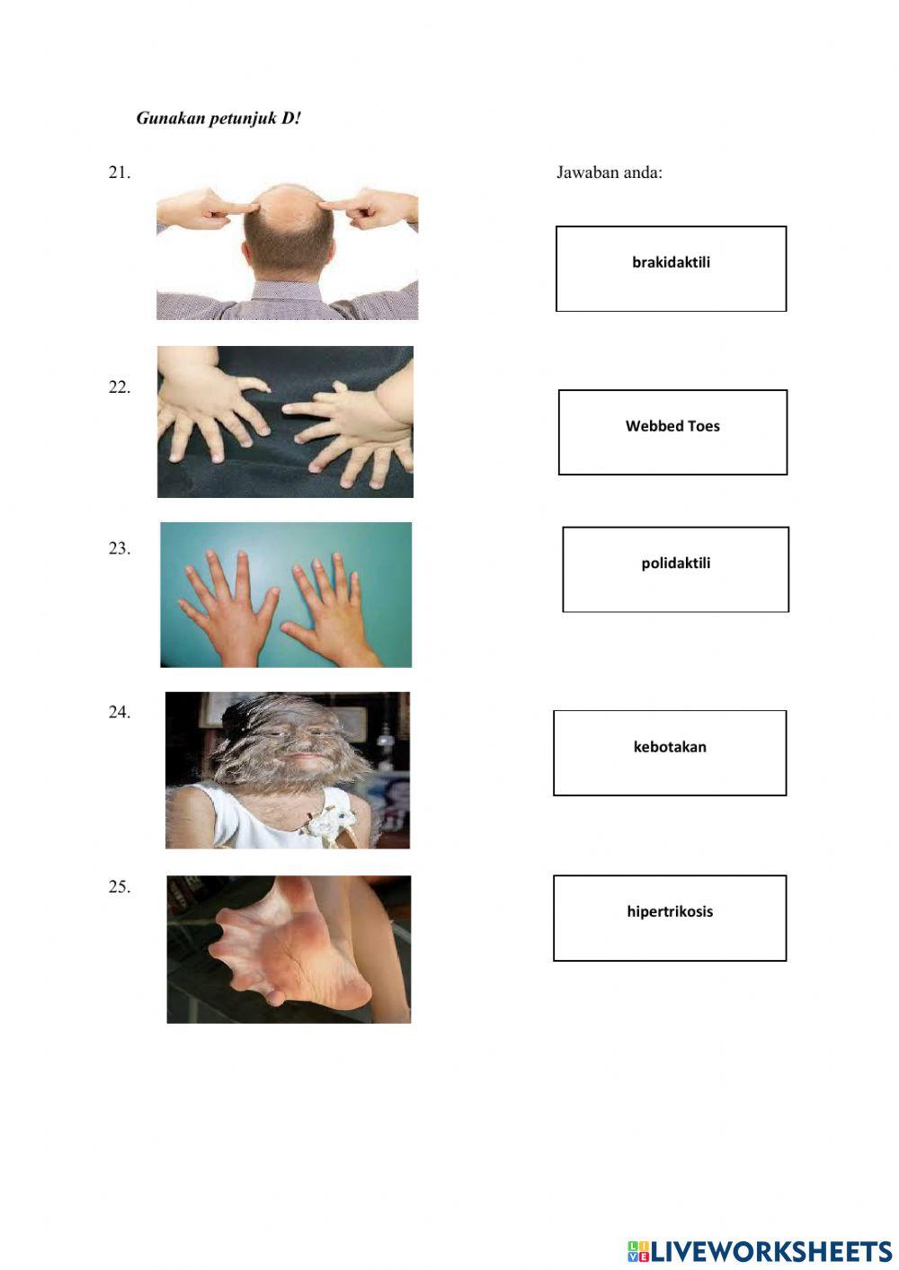 Soal Latihan Modul Hereditas Pada Manusia